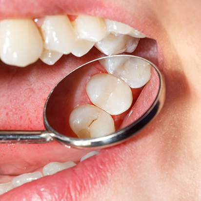 Close up of a dental mirror inside of a mouth