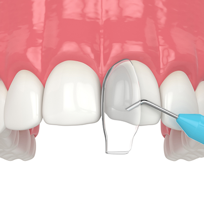 Illustration of bonding material being applied to a chipped tooth