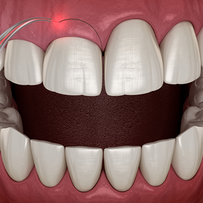 Illustration of a dental laser treating an uneven gumline