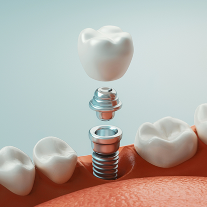 Illustration of a dental implant with a crown being placed into the lower jawbone