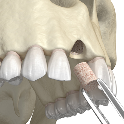 Illustration of bone grafting material being placed in the upper jawbone after tooth extraction