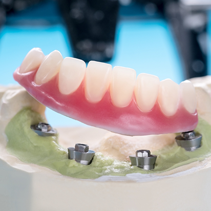 Model of an implant denture