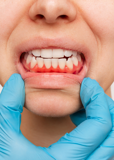 Person pulling down their lower lip to reveal red gums before gum disease treatment