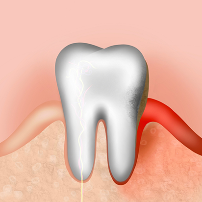 Side by side illustration of a healthy tooth and gums next to a decayed tooth and receding gumline