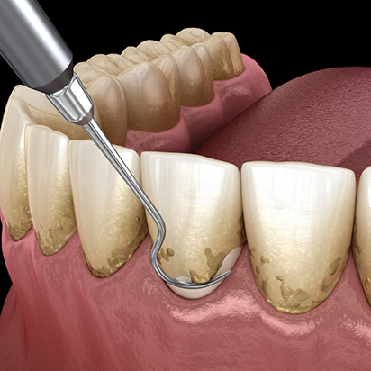 Illustration of dental scaler removing plaque buildup from gumline