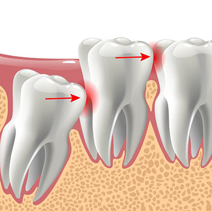 Illustration of an impacted wisdom tooth pressing against the adjacent tooth