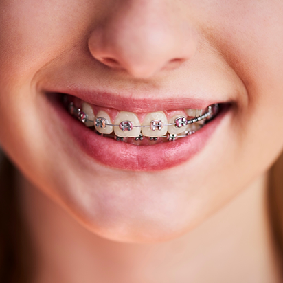 Close up of a young person smiling with traditional braces