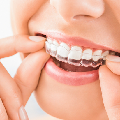 Close up of a person putting an Invisalign aligner over their teeth