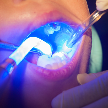 Close up of a child having dental sealants placed on their teeth