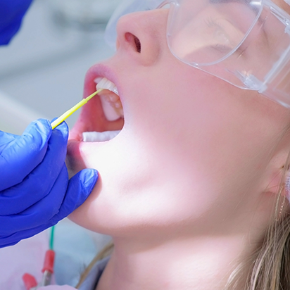 Close up of a dental patient having fluoride applied to their teeth