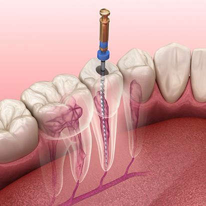 Illustration of dental instrument treating the inside of a tooth