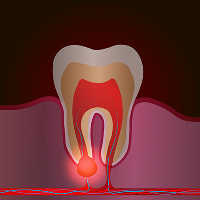 Illustration of an infected tooth with a bump under the root