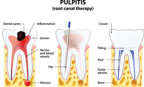 Morgan Hill Dental Care | Endodontics, Orthodontics and Implant Dentistry