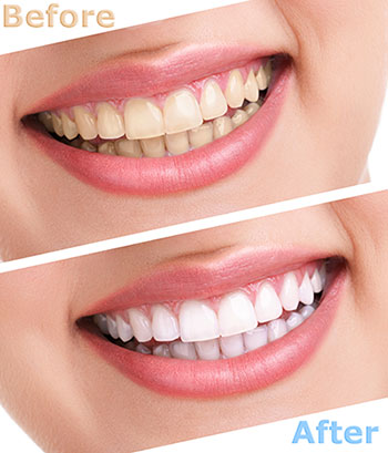 Morgan Hill Dental Care | Fillings, Bridges,   Crowns, Orthodontics and Implant Dentistry